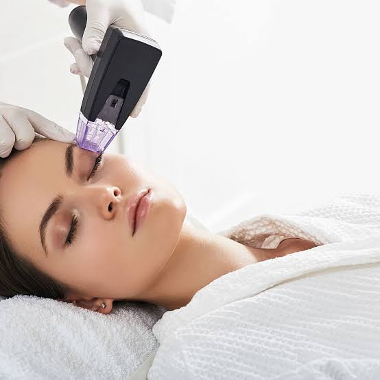 Morpheus8 facial treatment in progress